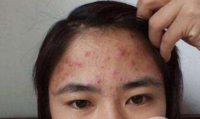 脸上出现这3个表现后，不好意思，是螨虫在脸上“打家劫舍”了