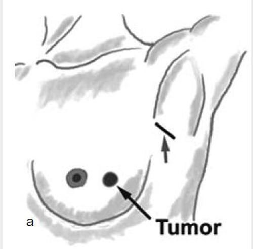 #手术#求美者对于假体隆胸手术切口该如何选择呢?