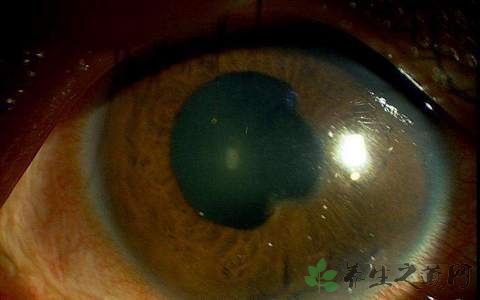 视网膜穿孔手术后注意事项
