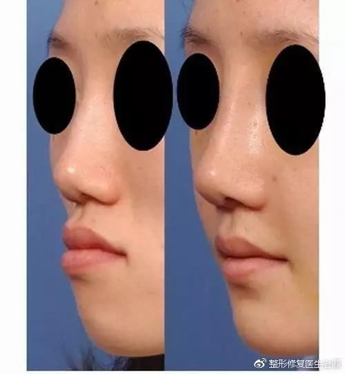 你连鼻基底是什么都不知道，还想有个好看的鼻子?