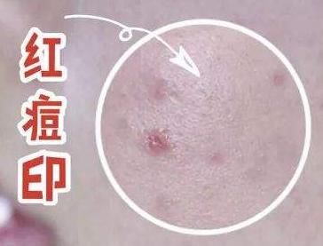 「痘印」为什么痘印老是消不掉?