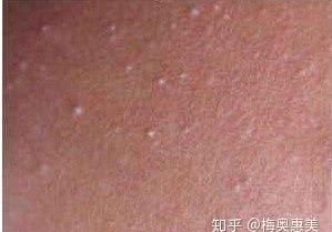  「正确」如何正确的祛痘痘